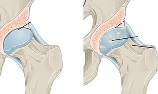 Sve o artrozi zgloba koljena: što je to, simptomi, uzroci, liječenje, prevencija