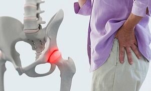 Simptomi i liječenje artroze zgloba kuka - Flekosteel