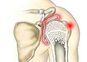 artroza liječenja ramena 2. stupnja