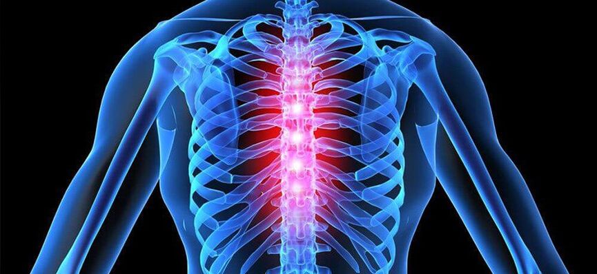 Akutna bol karakteristična je za pogoršanje osteohondroze torakalne kralježnice