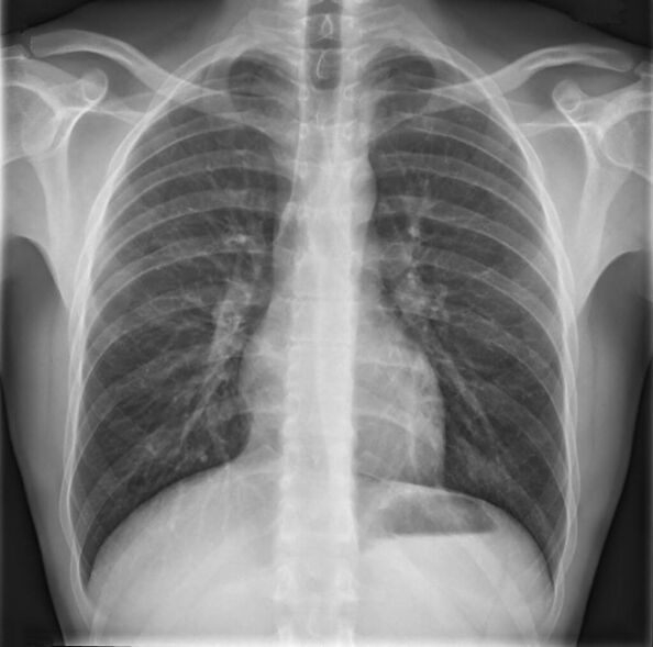 Osteokondroza torakalne kralježnice dijagnosticira se pomoću radiografije