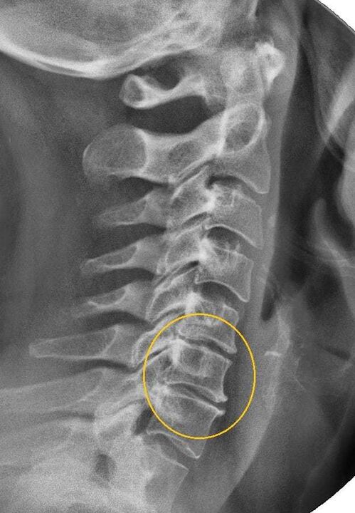 osteohondroza