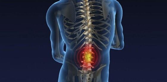 Bol u leđima s osteohondrozom lumbara