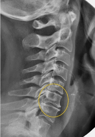 Osteohondroza kralježnice grlića maternice na x -ray