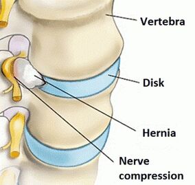 Osteohondroza cervikalne regije