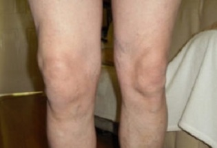 manifestacije artroze koljenskog zgloba (1)