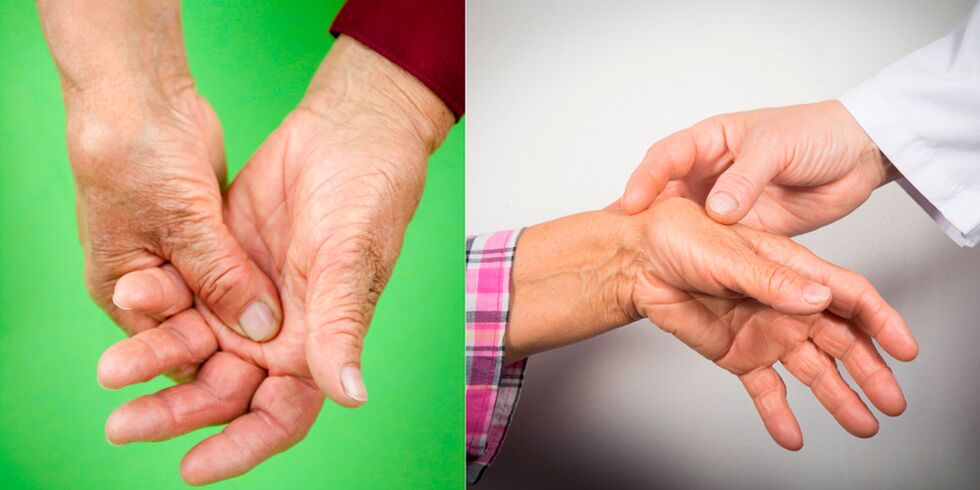 oticanje i bolni bolovi prvi su znakovi artritisa šake