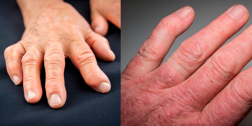 reumatoidni i psorijatični artritis ruku