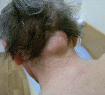 neoplazma kao uzrok bolova u vratu