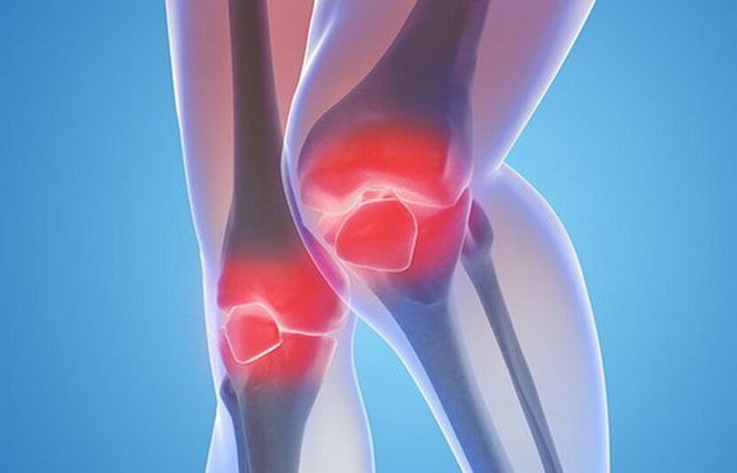 artroza zglobova koljena