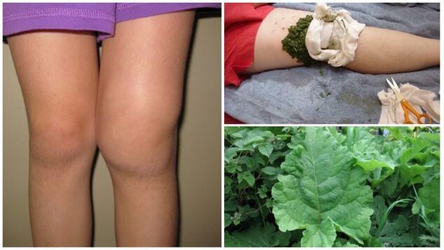 biljni oblog za artrozu koljena